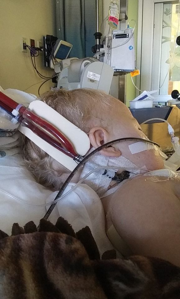 ECMO bypass